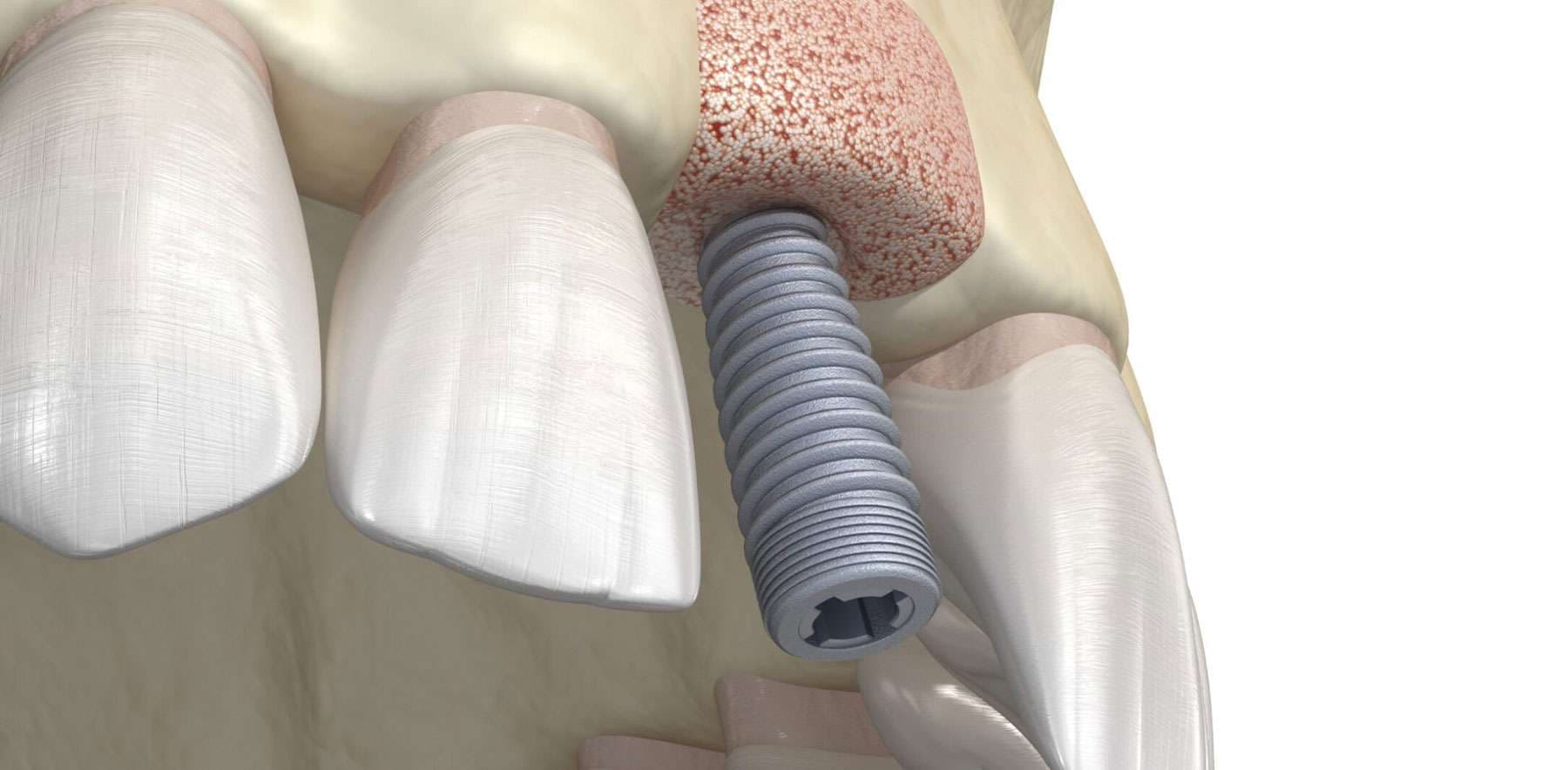 Understanding Bone Grafts for Dental Implants