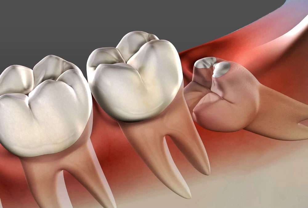 Wisdom Tooth Extraction