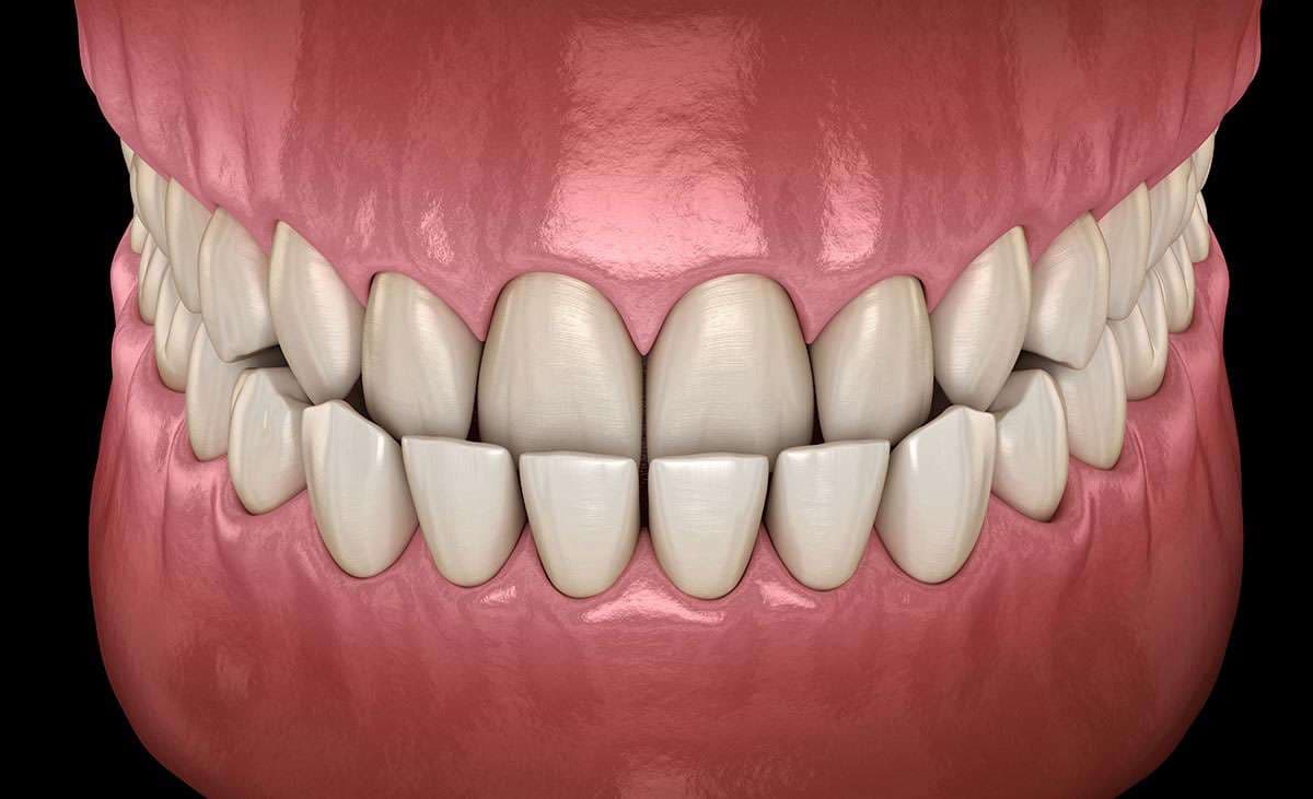 What is Underbite