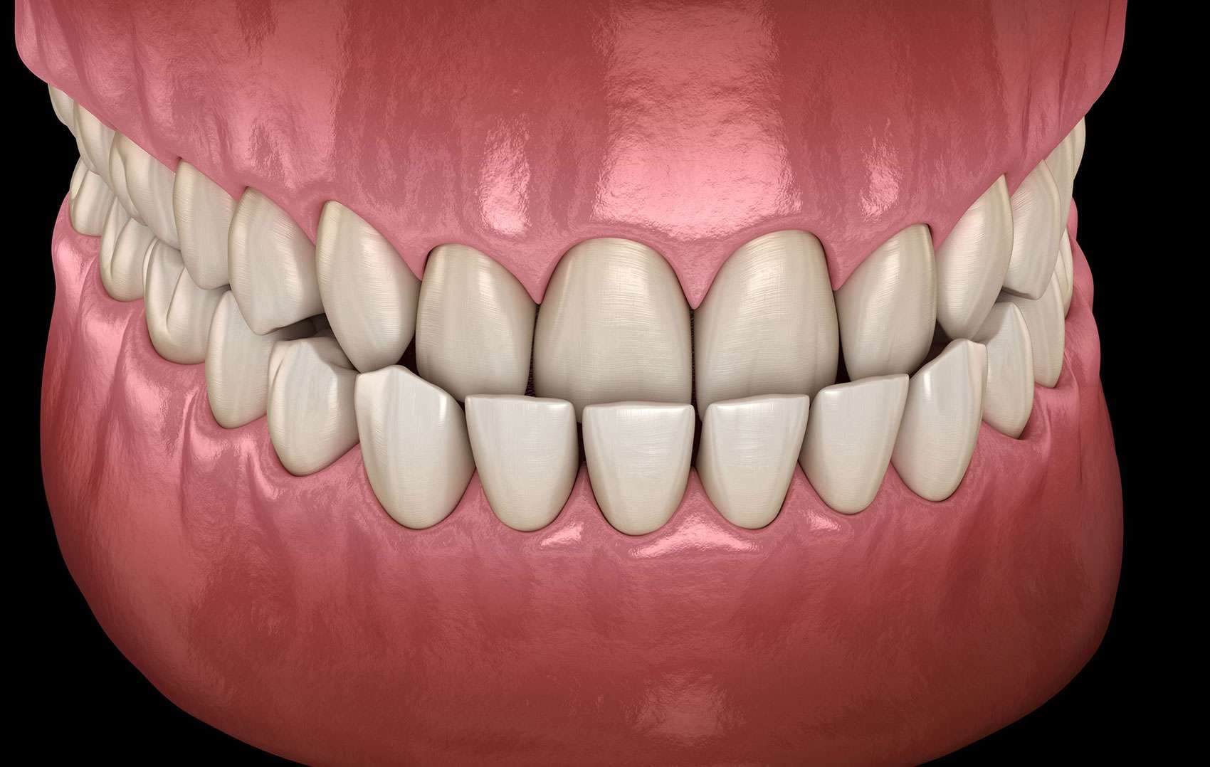 Mild Underbite vs. Severe Underbite