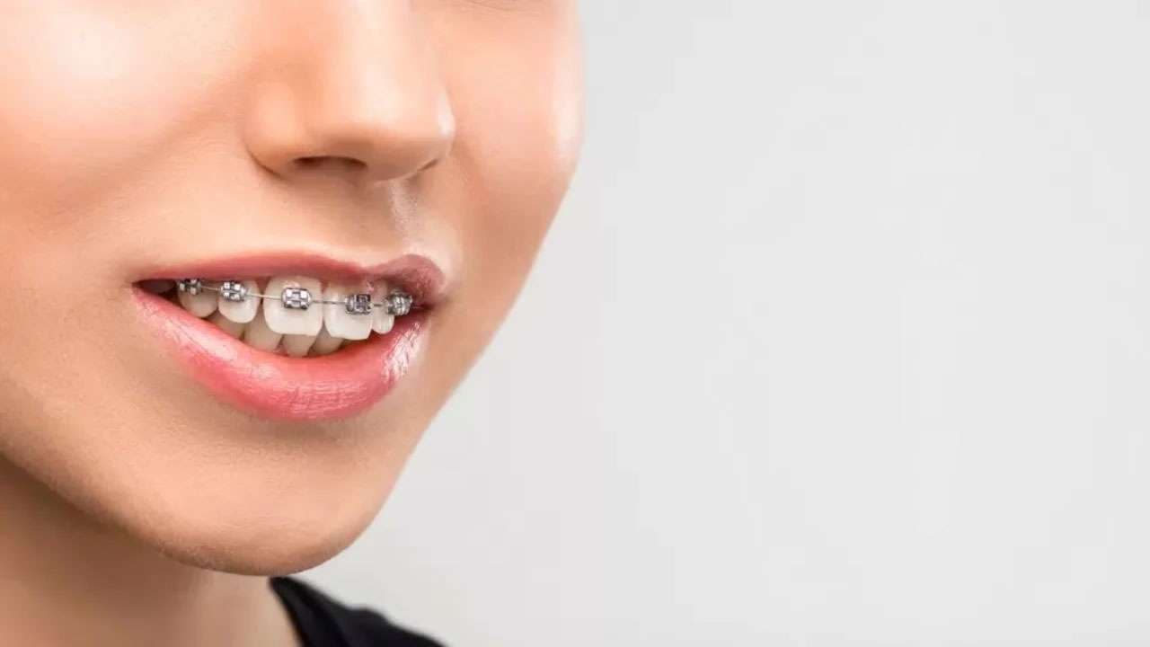 overbite