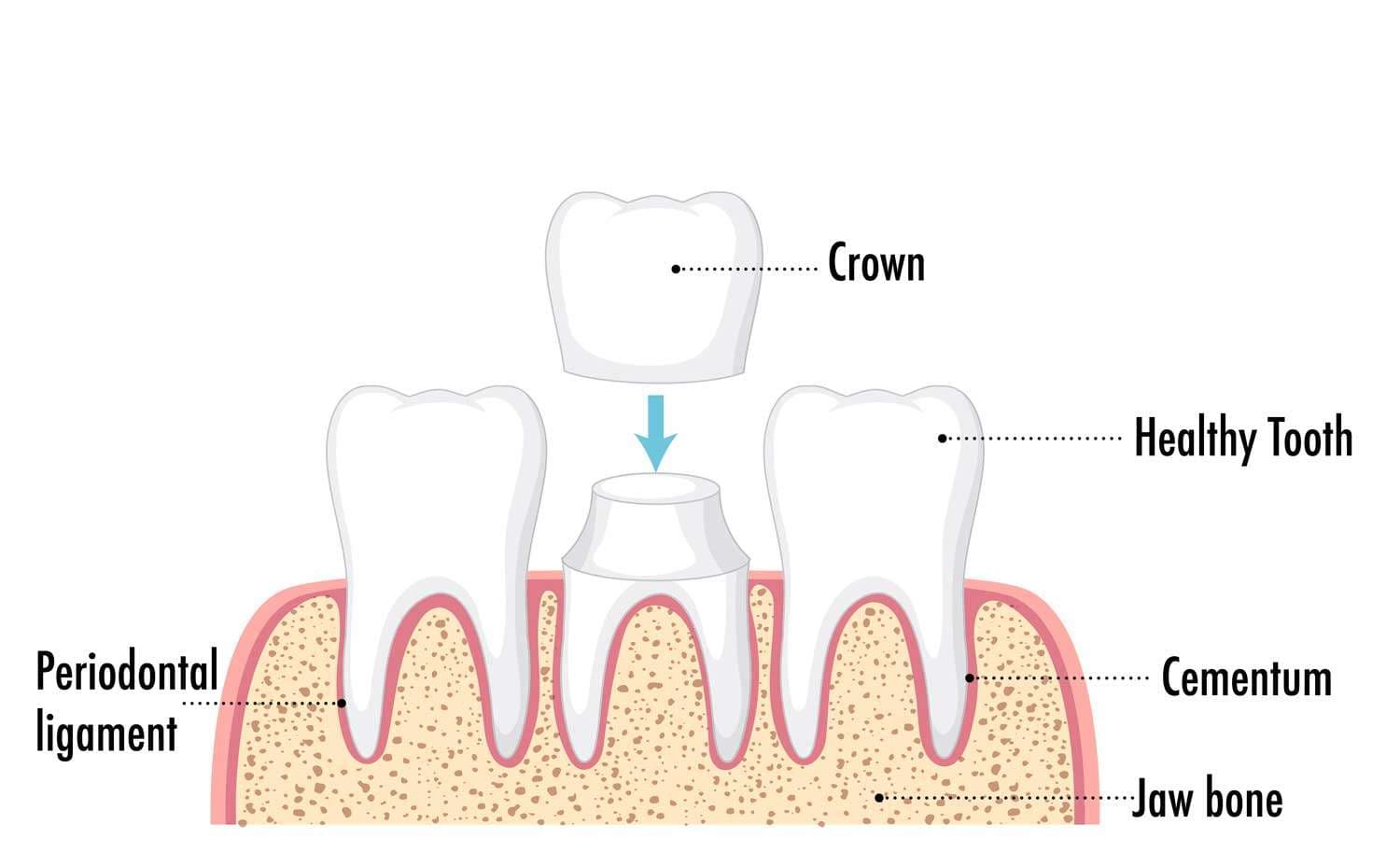 Cement in dentistry