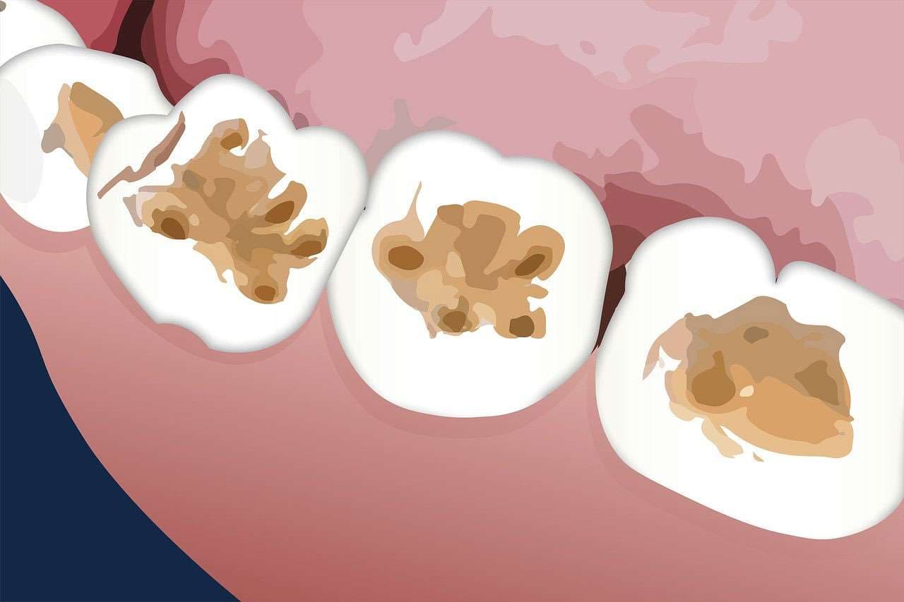 What Causes Cavities?