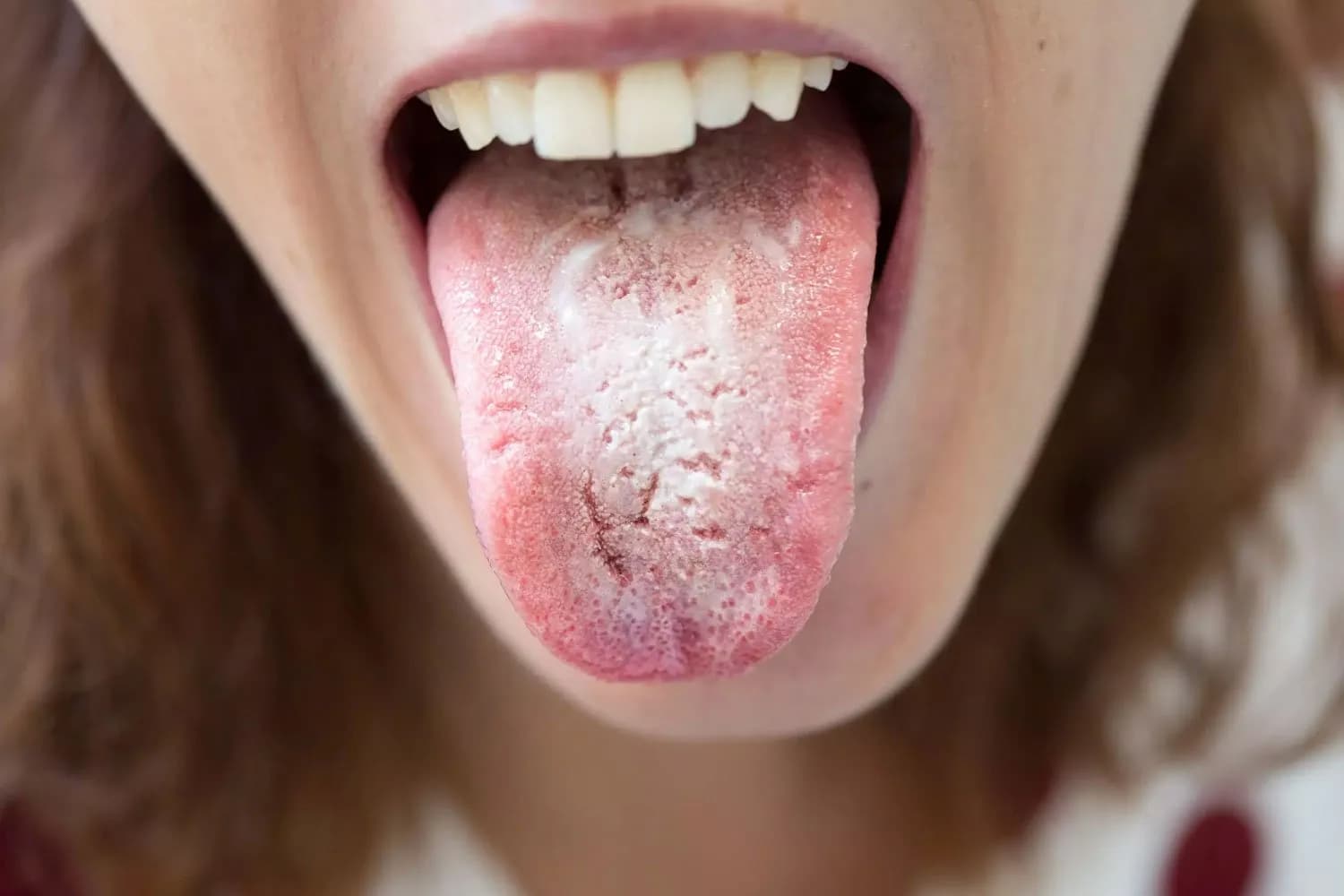 Hydrogen Peroxide and Oral Thrush