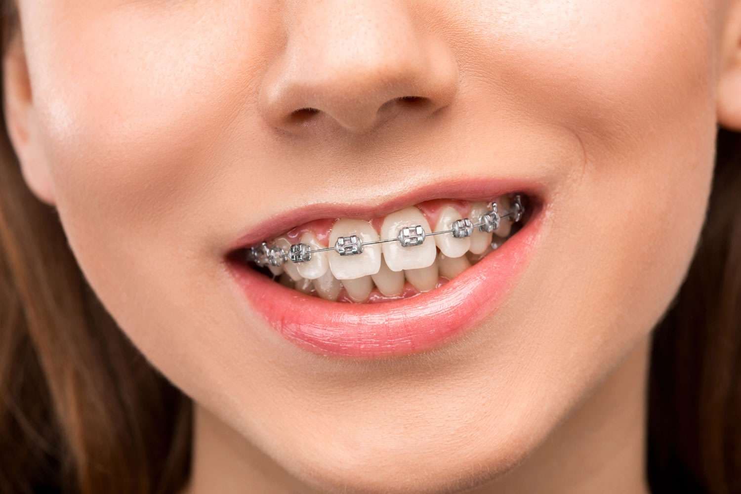 Before Braces