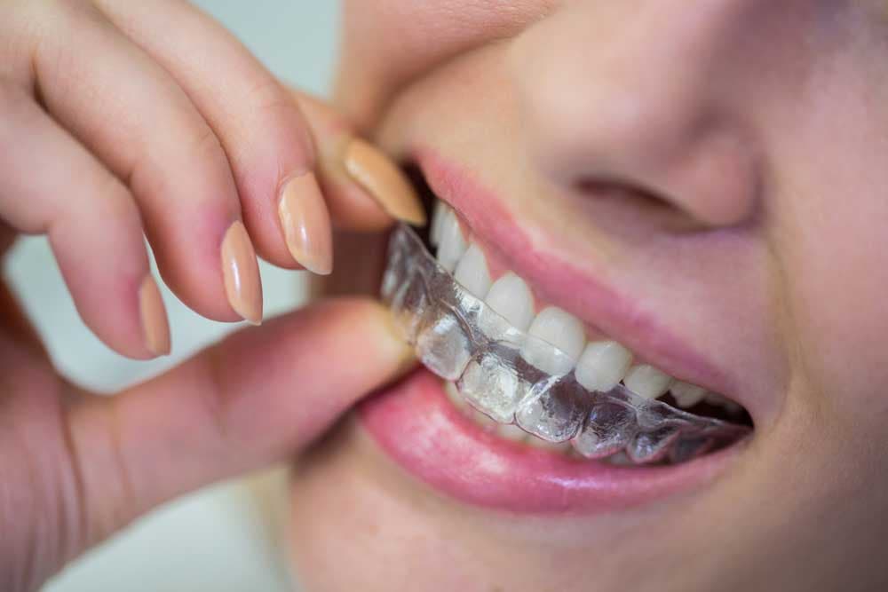 before getting dental braces