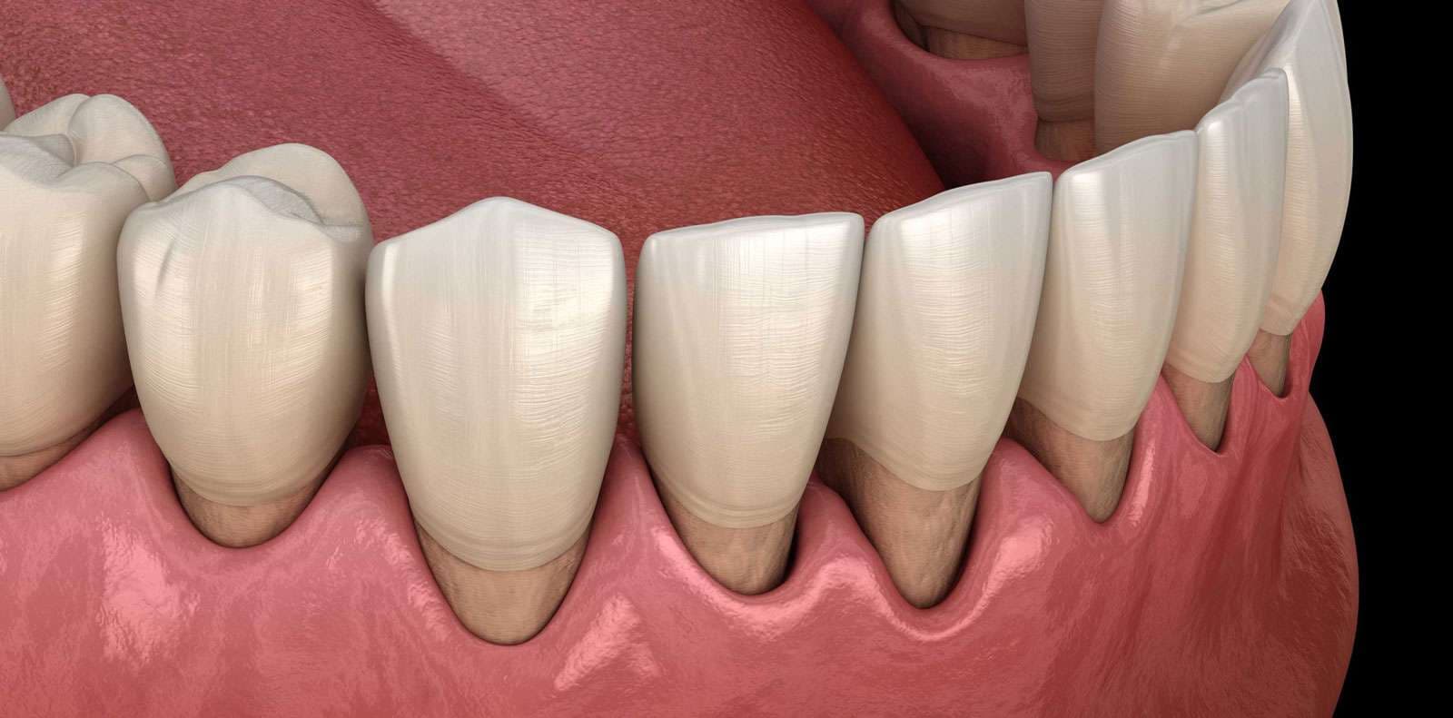 Gum Recession