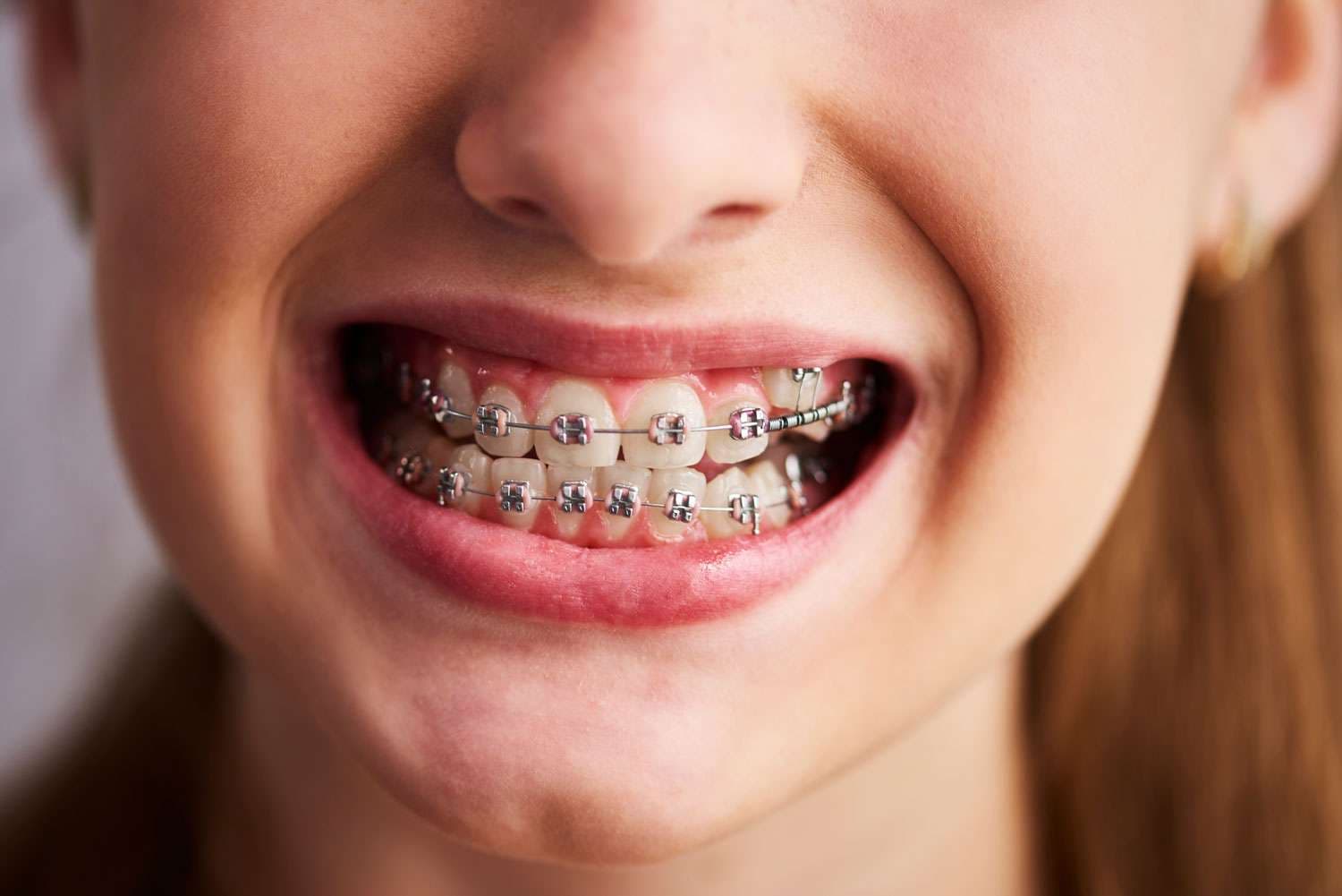 Dental Braces