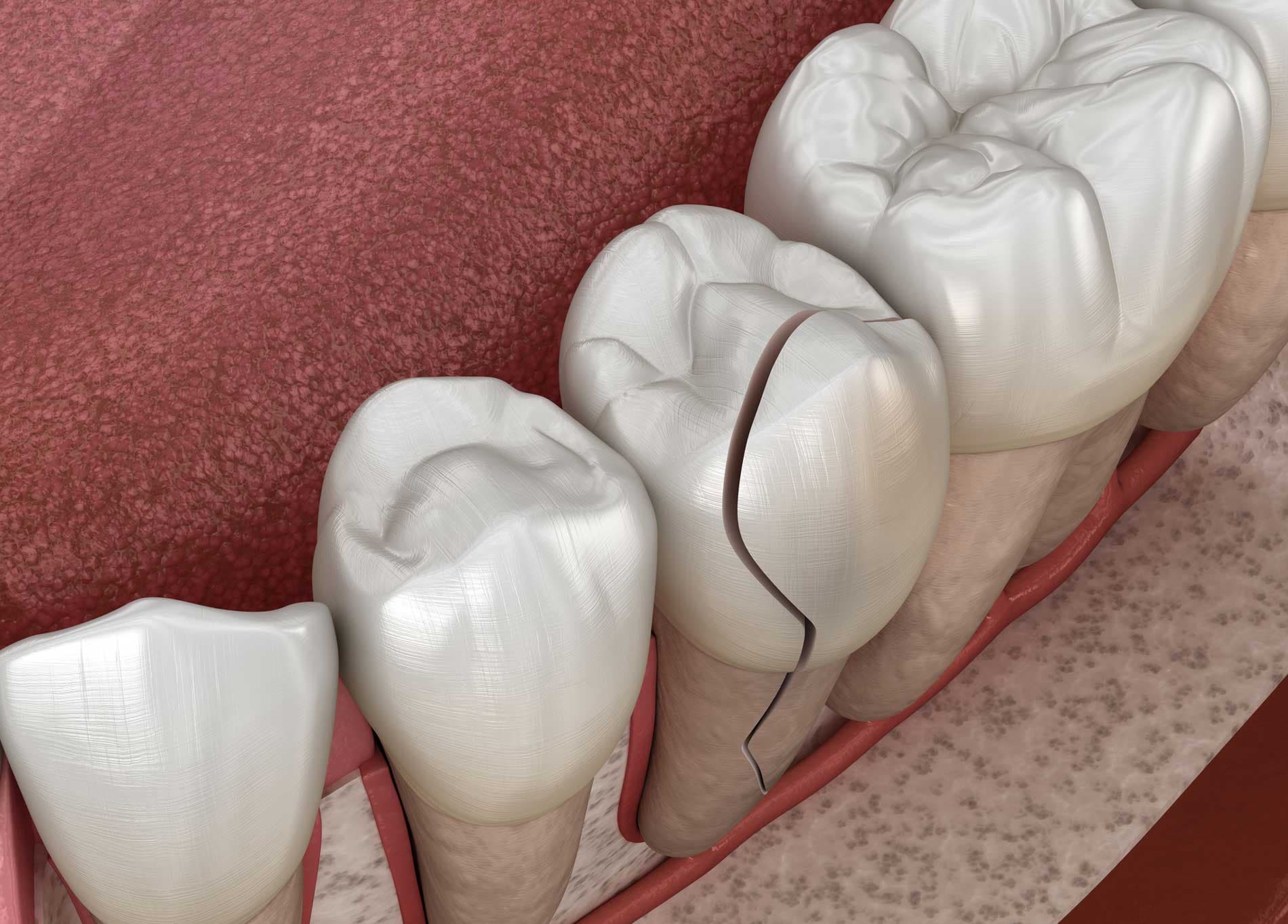 Repair Your Cracked Tooth