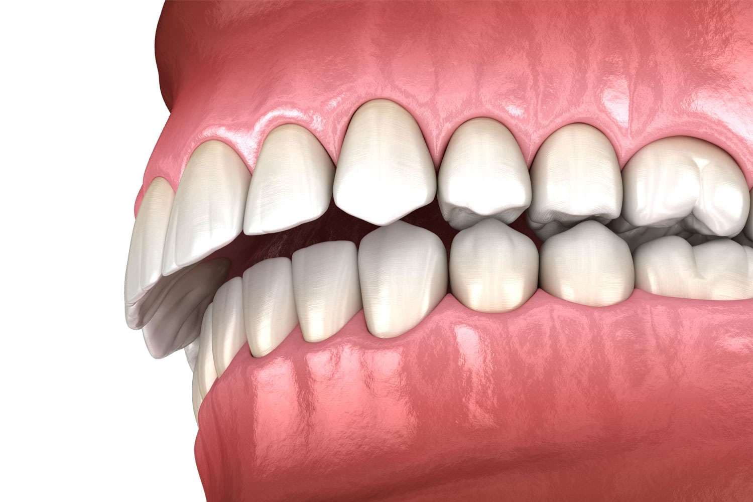 Orthodontic Treatment for Deep Bite